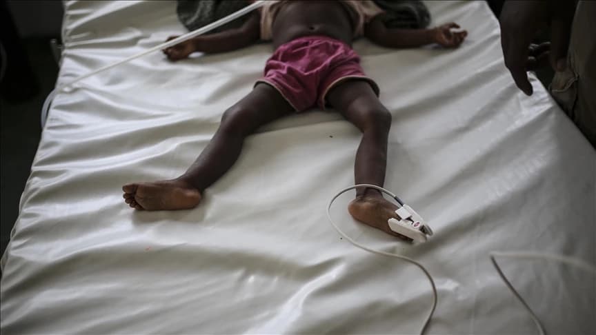 Morbili su značajan uzrok smrti djece, naročito u zemljama u razvoju