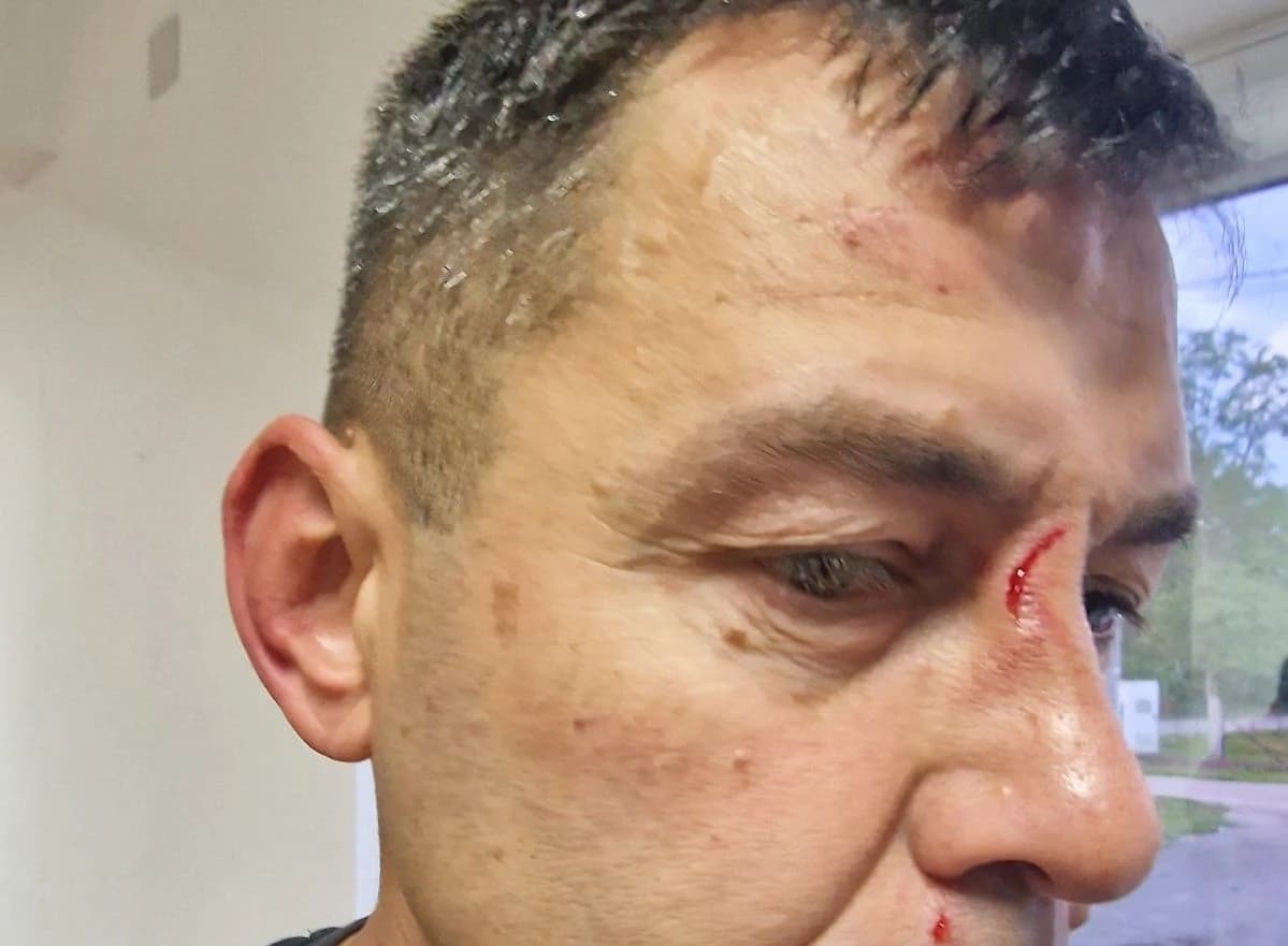 Arbitar sa vidnim povredama poslije meča