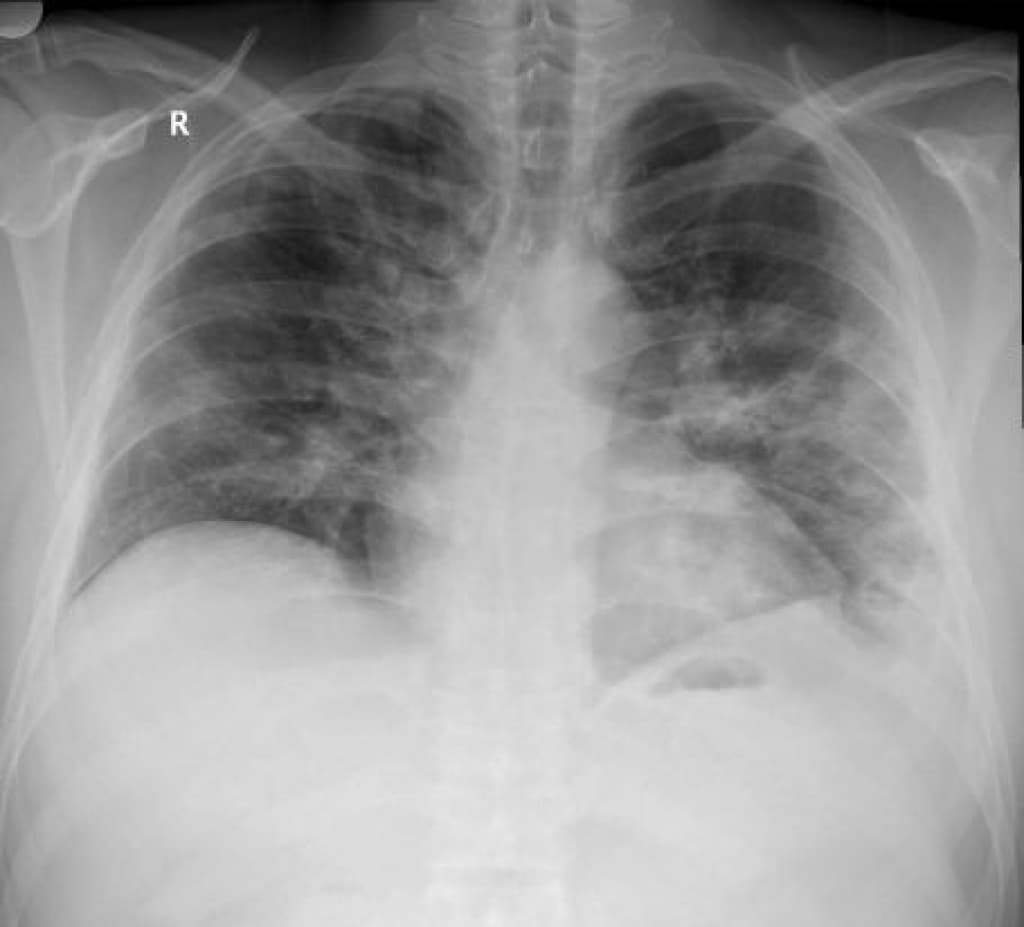 snimci pluća  (3).jpg